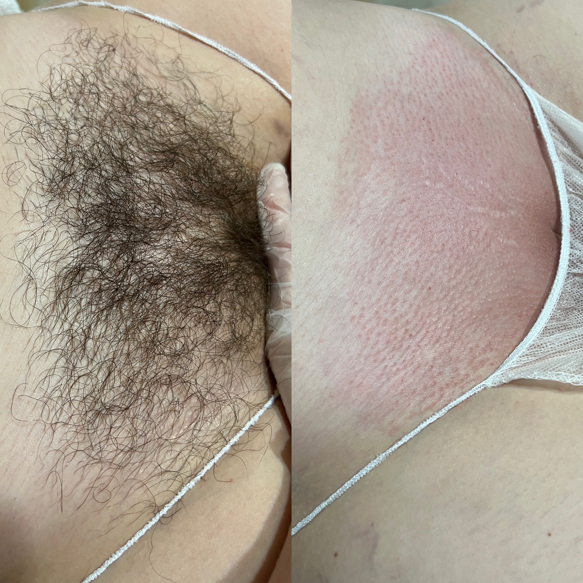 Brazilian_waxing.jpg